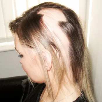Client with Alopecia before Enhancer system was fitted