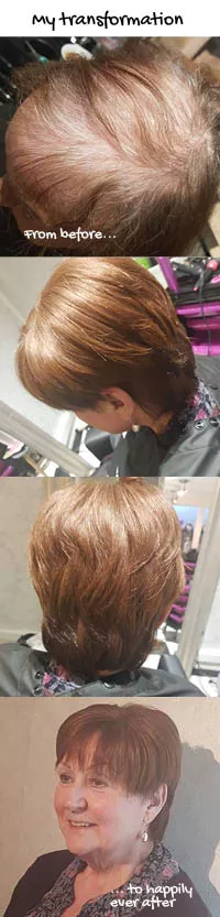 Client with thyroid related hair loss